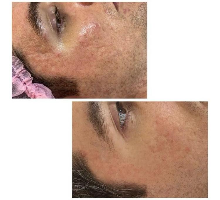 Dark Spot Face Cream with Kojic Acid